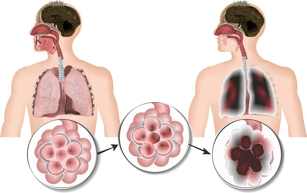 In den Lungenbläschen findet der Gas-Austausch statt. rechts eine gesunde Lunge, links eine Lunge mit COPD. Schädliche Partikel führen zu Entzündungen der Schleimhäute der Lungenbläschen.  Rechts zu sehen: Die Membrane brechen zusammen. Bild: Fotolia